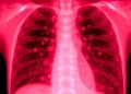 Hospital-acquired pleural infection shows worse outcomes than community-acquired cases