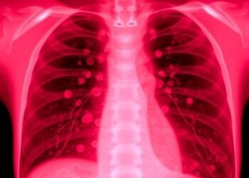 Hospital-acquired pleural infection shows worse outcomes than community-acquired cases