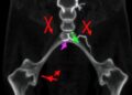 IRX1 blocks cervical cancer growth by curbing lipid synthesis enzyme ACLY