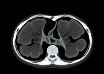 Mamba-Based AI Sharpens Medical Image Segmentation With Position Awareness and Dynamic Upsampling