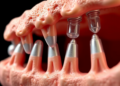 Mildly Alkaline Implant Surfaces Enlist Neutrophils to Fight Infection and Rebuild Bone