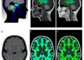 Multi-institutional RAPID Consortium analysis of molecular therapy for papillary craniopharyngioma