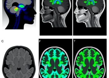 Multi-institutional RAPID Consortium analysis of molecular therapy for papillary craniopharyngioma