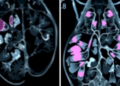New AI Pipeline Sorts Breast Tissue Scans Into Benign and Malignant With Striking Accuracy