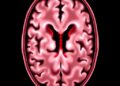 Risk factors for shunt conversion and brain bleeding after ventriculosubgaleal shunts