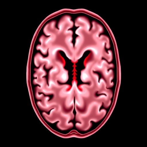 Risk factors for shunt conversion and brain bleeding after ventriculosubgaleal shunts