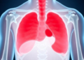 Simple Blood Ratio Predicts Survival in Young Bone Cancer Patients