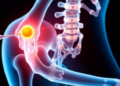 Smart Bone-Seeking Nanocarrier Releases Osteoporosis Drug Only Where Oxygen Runs Low