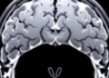 Sudden Stress Surges, Not Chronic Load, Push Cancer Cells Toward Invasive Growth, MRI-Tracking Sensors Reveal