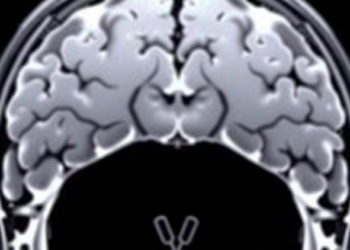 Sudden Stress Surges, Not Chronic Load, Push Cancer Cells Toward Invasive Growth, MRI-Tracking Sensors Reveal