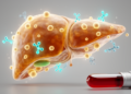 Blood Marker Soluble PD-1 Flags Cancer Return After Liver Transplant in Immunotherapy Patients