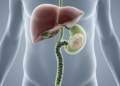 Hidden Bile Duct Tumor Masquerades as Gallstones in Landmark Case Report
