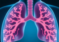 Inhaled Colistin Plus IV Colistin Beats Other Antibiotic Combos for Drug-Resistant Pneumonia in Chinese Cohort