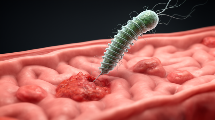 Stomach bacterium H. pylori may drive one in five colorectal cancer cases worldwide