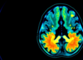 PSMA PET/CT-guided biopsy finds hidden prostate cancers that MRI misses