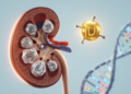 Vitamin D Levels and Receptor Gene Variants Combine to Drive Kidney Stone Risk