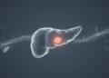 AI Model Flags Pancreatic Cancer Risk Up to Three Years Before Diagnosis