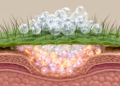 Stinging nettle hairs and nanoliposomes team up to deliver psoriasis drug through thickened skin