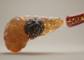 AFP Elevation in Pancreatic Cancer Linked to Advanced Stage