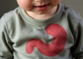 Silent Stomach Ulcers in Children Can Hide Behind Simple Anemia