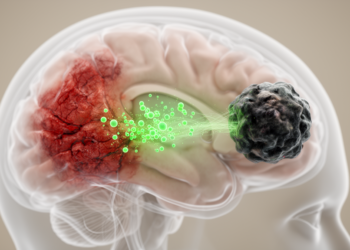 How Stroke Injury Feeds the Brain's Deadliest Tumors
