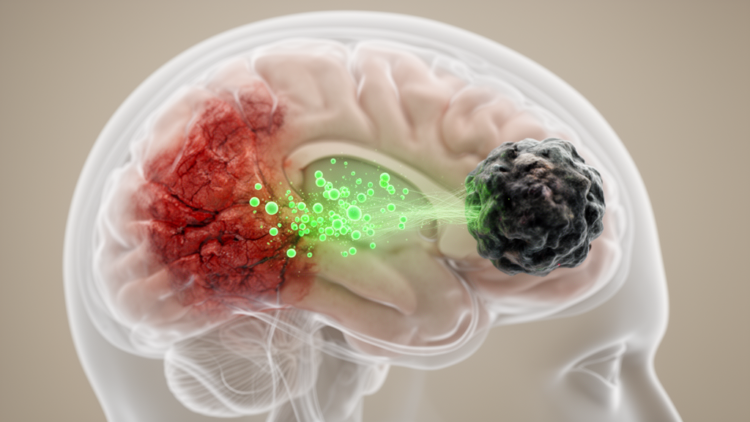 How Stroke Injury Feeds the Brain's Deadliest Tumors