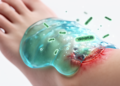 Smart Gel Accelerates Healing of Infected Diabetic Wounds