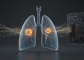 AI Reads the Whole Lung to Predict Which Cancer Patients Will Benefit From Immunotherapy