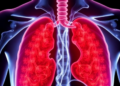 Immunochemotherapy Before Surgery Cuts Recurrence Risk in Esophageal Cancer, Meta-Analysis Finds
