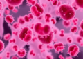 HIV-Linked Blood Cancers Strike Younger Patients and Cut Survival, Single-Center Study Finds