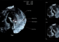 AI Meets Ultrasound: Hybrid Deep Learning Models Sharpen Breast Cancer Detection