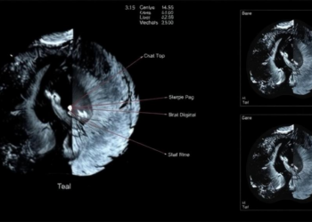 AI Meets Ultrasound: Hybrid Deep Learning Models Sharpen Breast Cancer Detection