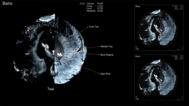 AI Meets Ultrasound: Hybrid Deep Learning Models Sharpen Breast Cancer Detection