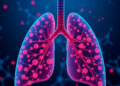 Lung cancer rewires its metabolism into a dynamic, adaptive network
