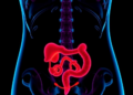 AI Models Predict Radiation Gut Damage in Cervical Cancer—but Are They Ready for the Clinic?