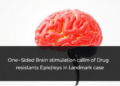 One-Sided Brain Stimulation Calms Drug-Resistant Epilepsy in Landmark Case