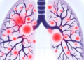Chicken-fat clots linked to neutrophil buildup in lung vessels, autopsy study finds