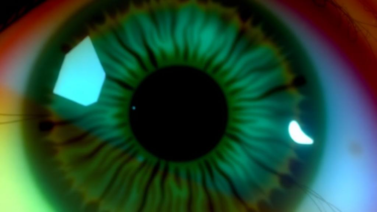 Multimodal AI Classifies Herpes Simplex Keratitis Subtypes Across Three Eye Centers