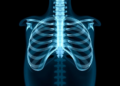 Older Women and Recurrent TB Face Higher Risk of Bone and Joint Tuberculosis, Study Finds