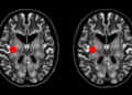 Deep Autoencoder Embeddings Sort Brain Tumor MRI Scans Without Labels