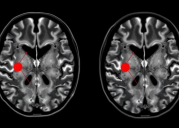 Deep Autoencoder Embeddings Sort Brain Tumor MRI Scans Without Labels
