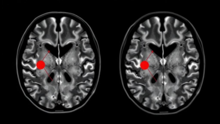 Deep Autoencoder Embeddings Sort Brain Tumor MRI Scans Without Labels