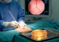 From Lasers to Shape-Shifting Polymers: New Weapons Against the Silent Leak That Threatens Aneurysm Repairs