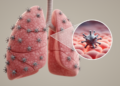 Lingering Viral Spike Protein Found in the Lungs of Long COVID Patients