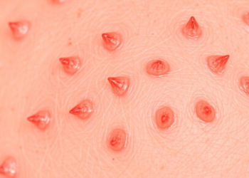 Itchy Skin Condition Prurigo Nodularis Linked to Skin Cancer Risk in Large Cohort Study