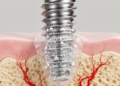 Sodium alginate and collagen-loaded troxerutin improve mineralization and vascularization around implants