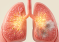 Chronic Lung Infection Surprisingly Sustains Gene Therapy Expression in Cystic Fibrosis Rat Lungs