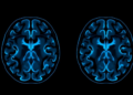 AI Reads Routine MRI Scans to Predict Brain Invasion in Meningiomas Before Surgery