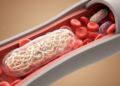 Mitochondria in Severe Leg Artery Disease Lose Their Ability to Recover After Revascularisation