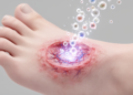 Exosome Therapy Shows Promise for Diabetic Wounds, but Key Evidence Remains Scarce